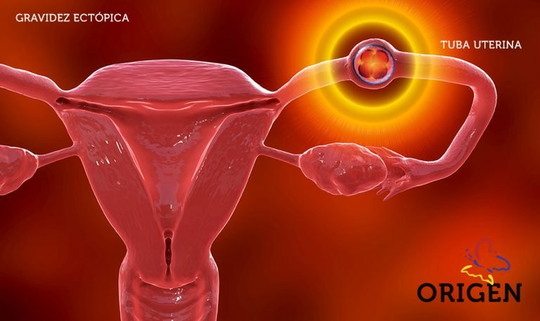 Gravidez ectópica conheça as causas Clínica Origen Fertilização in