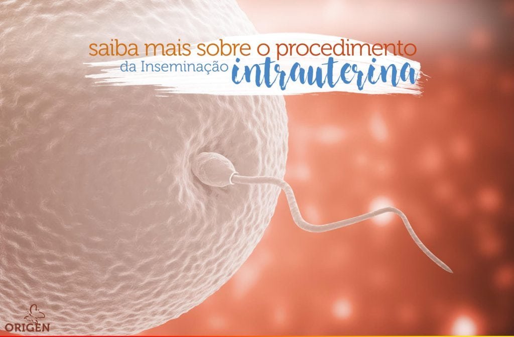 Inseminação Intrauterina Iiu Saiba Mais Sobre O Procedimento Clínica Origen Fertilização 7637