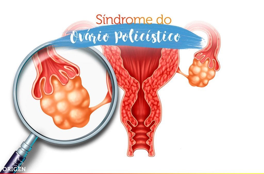 sindrome-do-ovario-policistico-o-que-e-quais-os-sintomas-e-tratamentos