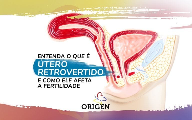 Útero Retrovertido Entenda O Que é E Como Ele Afeta A Fertilidade