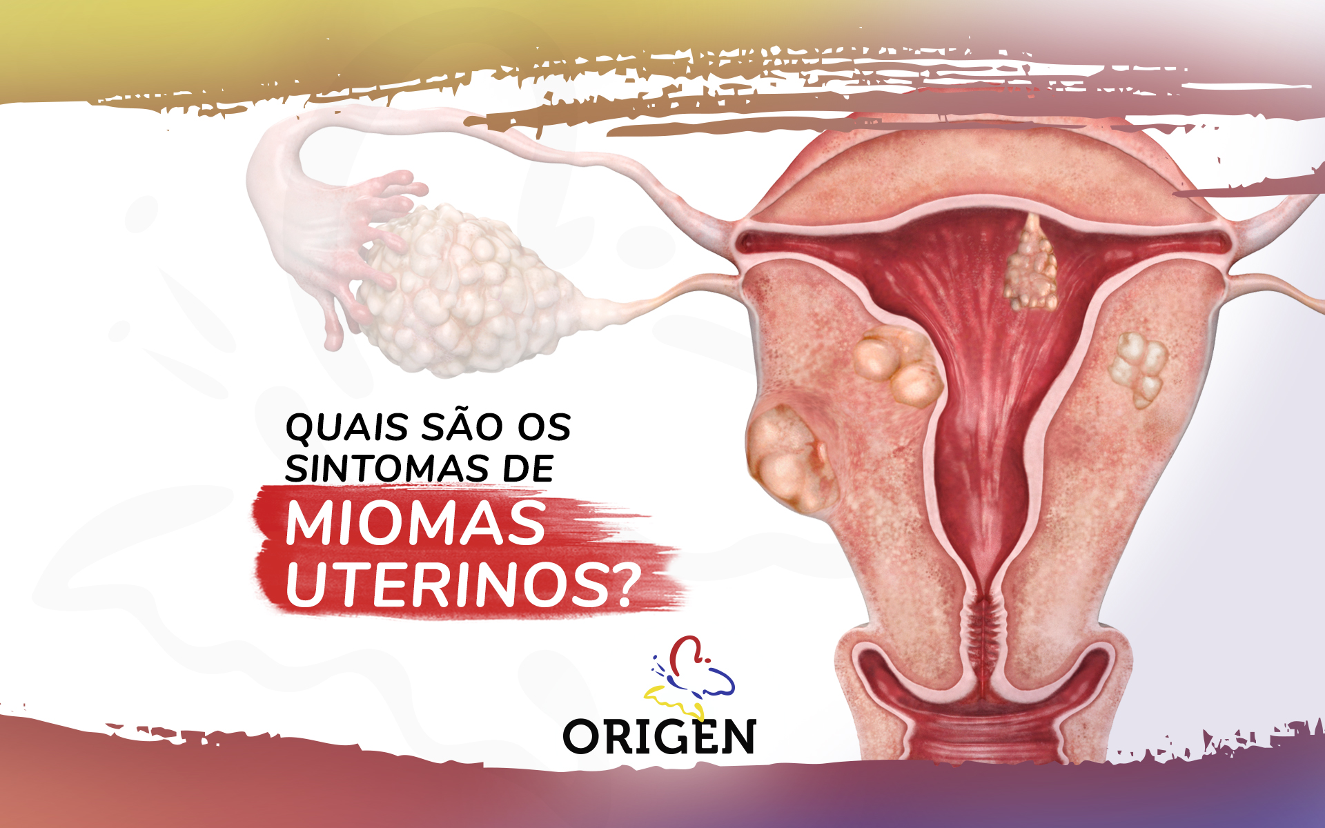 Quais são os sintomas de miomas uterinos?