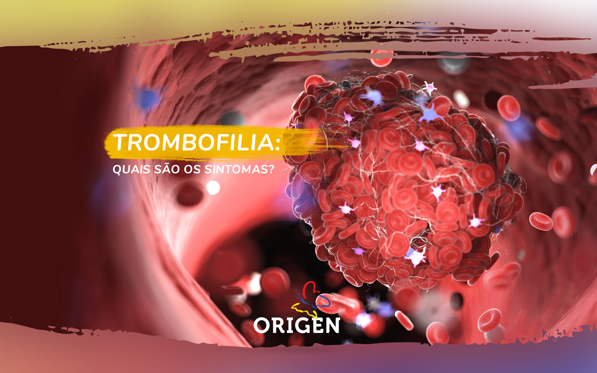 Trombofilia: quais são os sintomas?