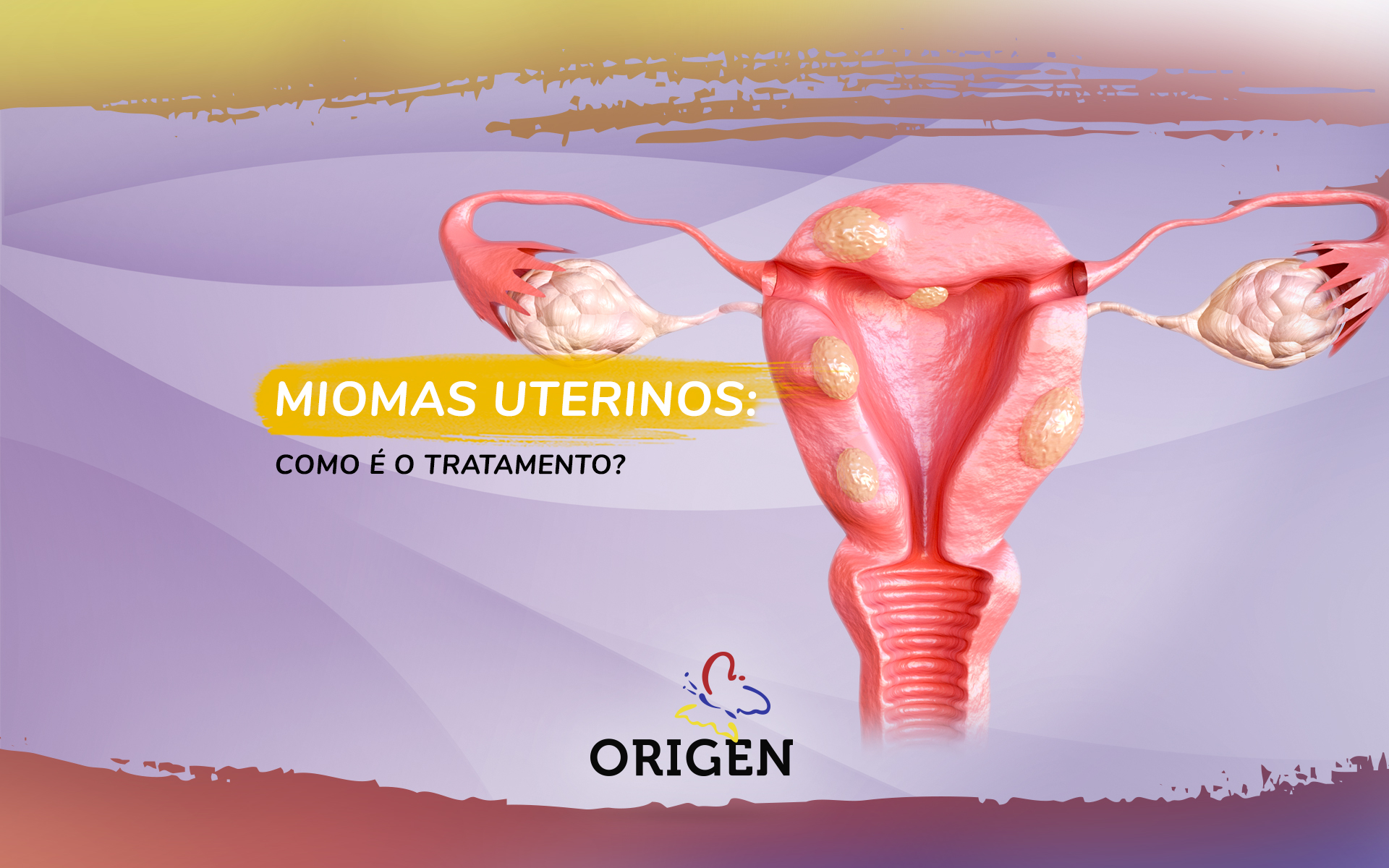 Miomas uterinos: como é o tratamento?