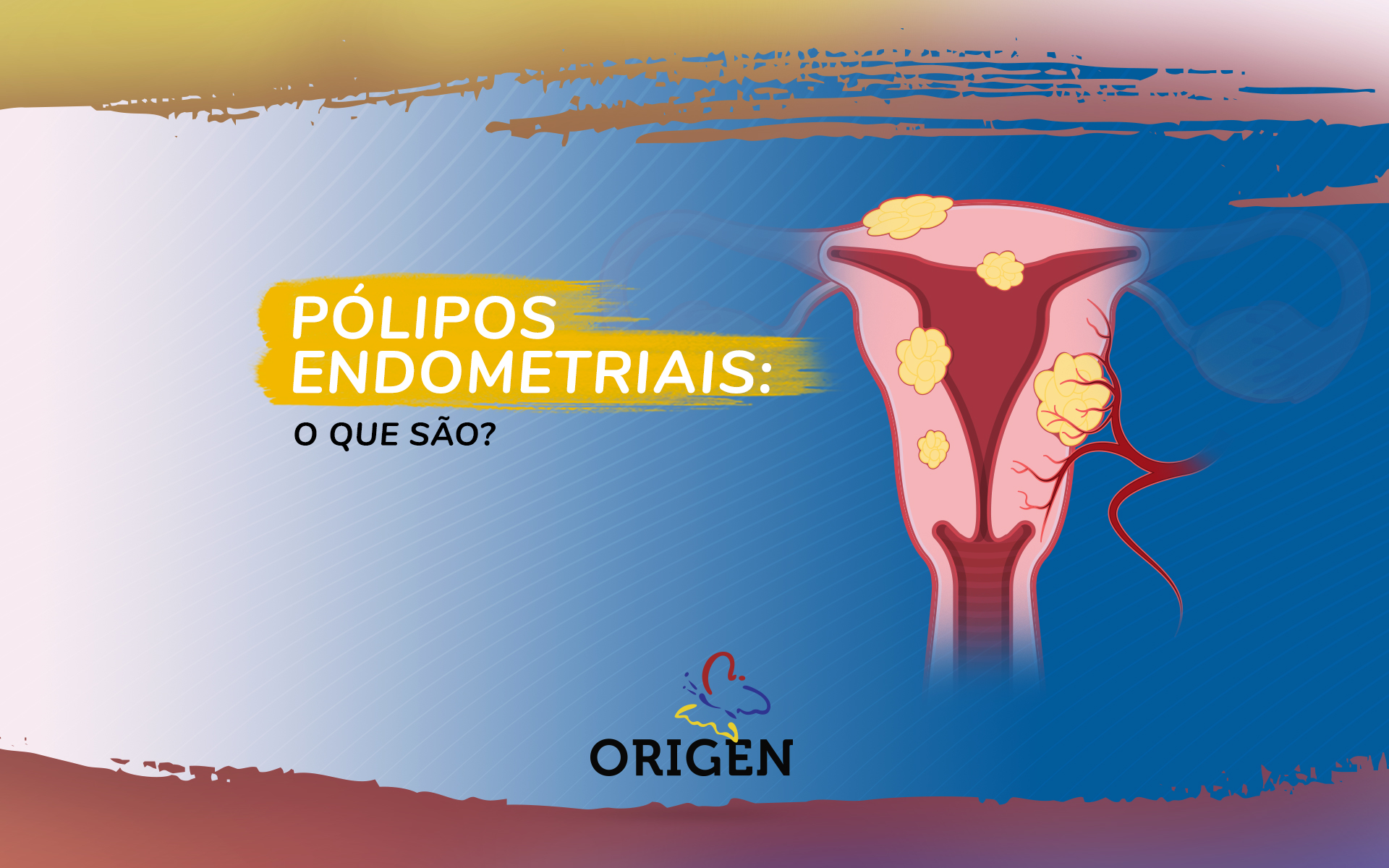 Pólipos endometriais: o que são?