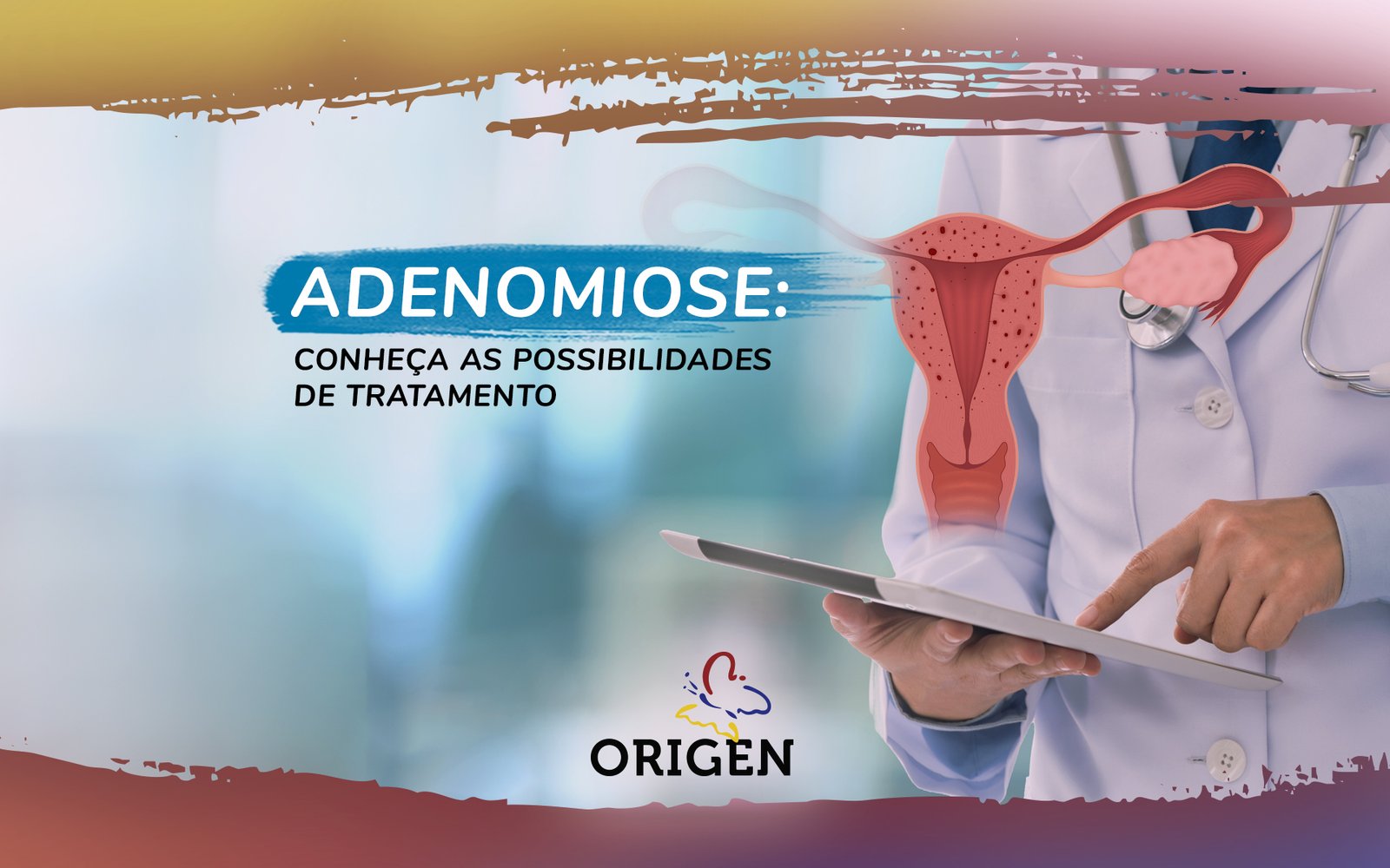 Adenomiose: conheça os sintomas