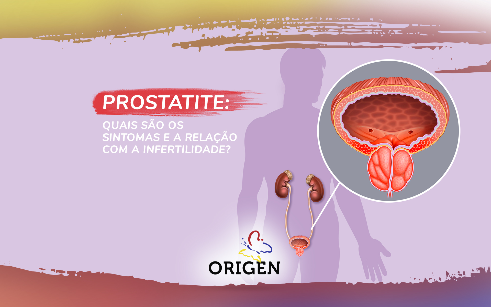 Prostatite: quais são os sintomas e a relação com a infertilidade?