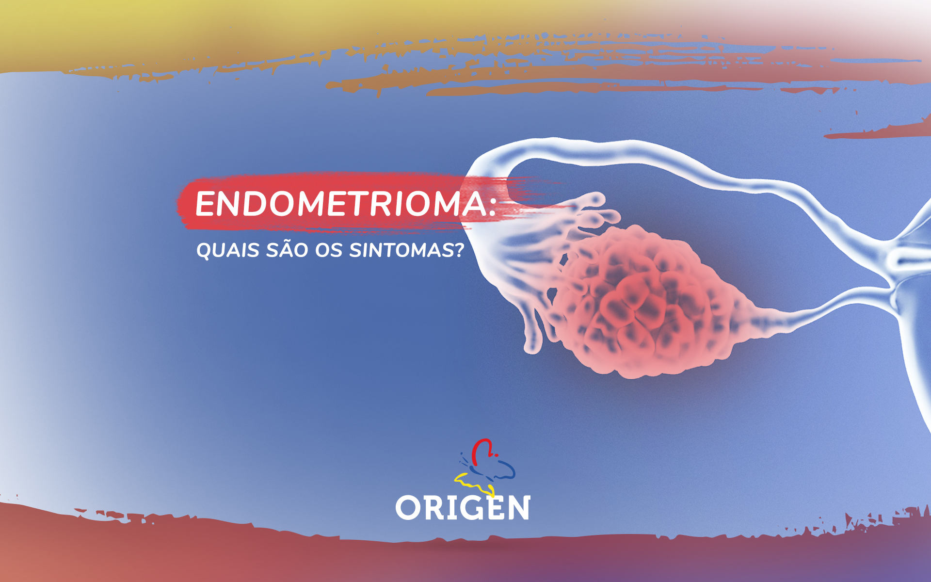 Endometrioma: quais são os sintomas?