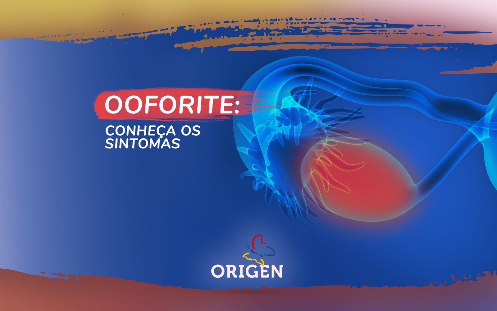 Ooforite - Saiba tudo sobre Ooforite