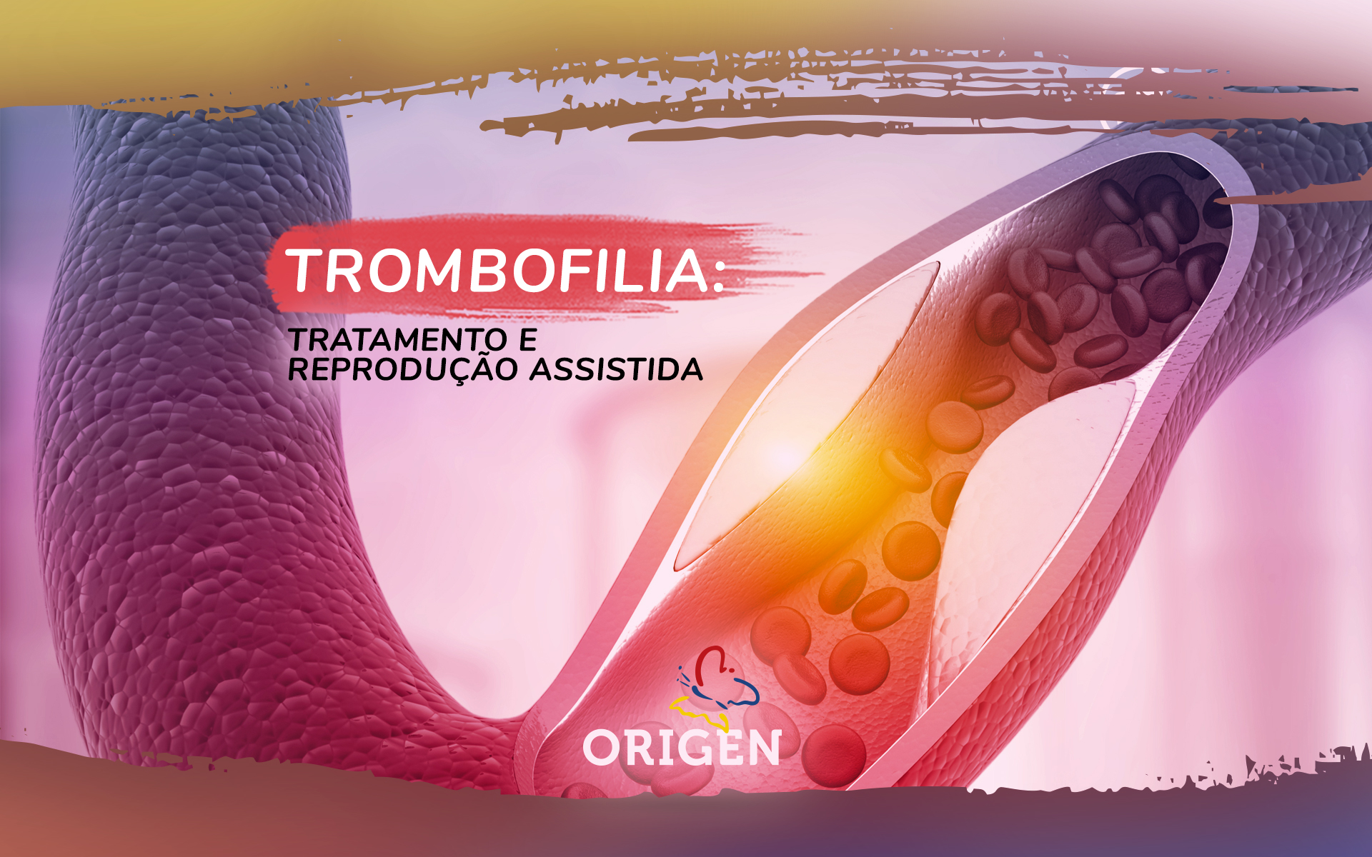 Trombofilia: tratamento e reprodução assistida