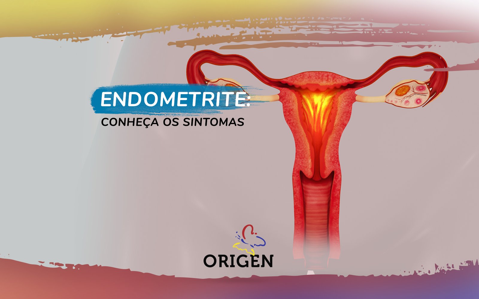 Endometrite: veja quais são os sintomas - Clínica Reproduce