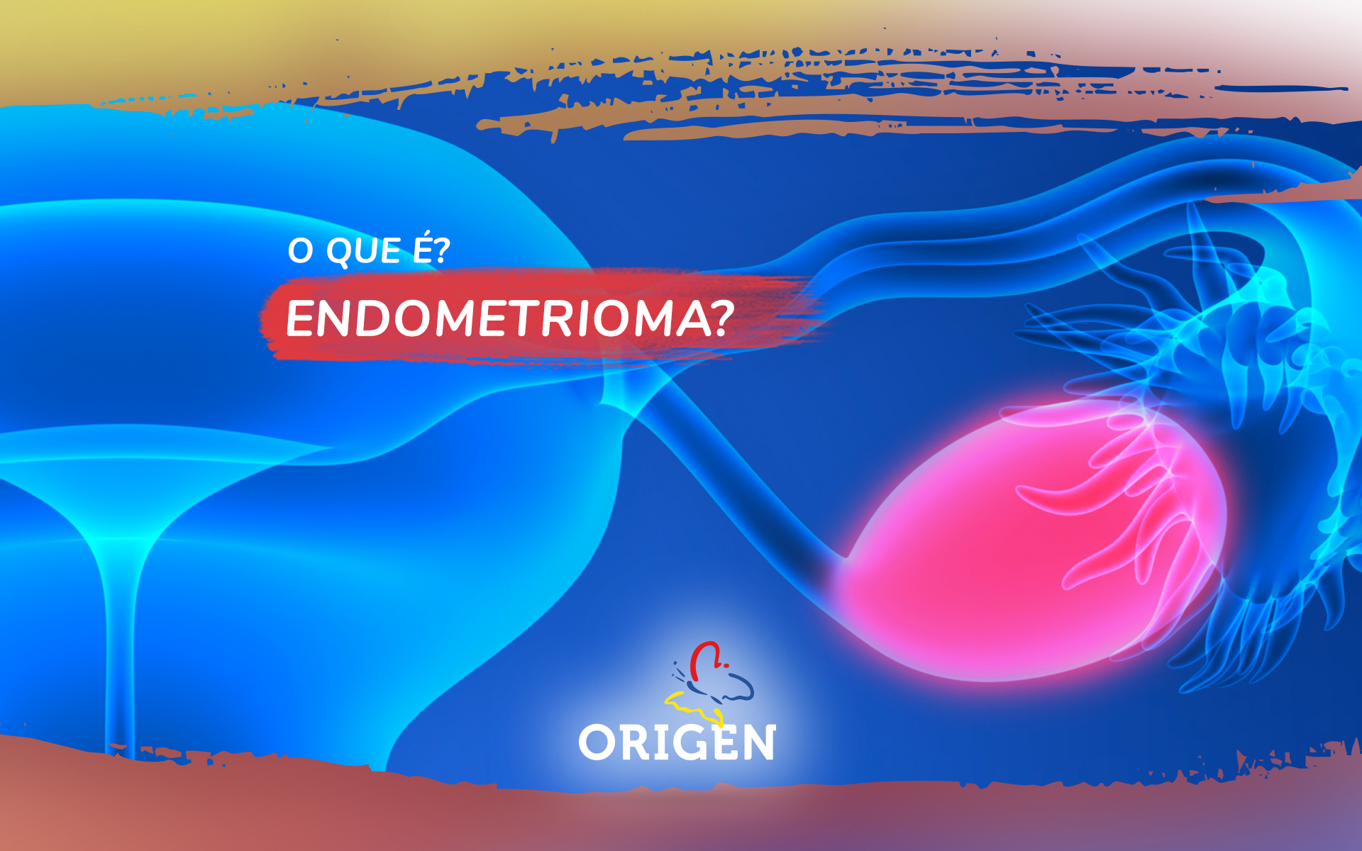 O que é endometrioma?