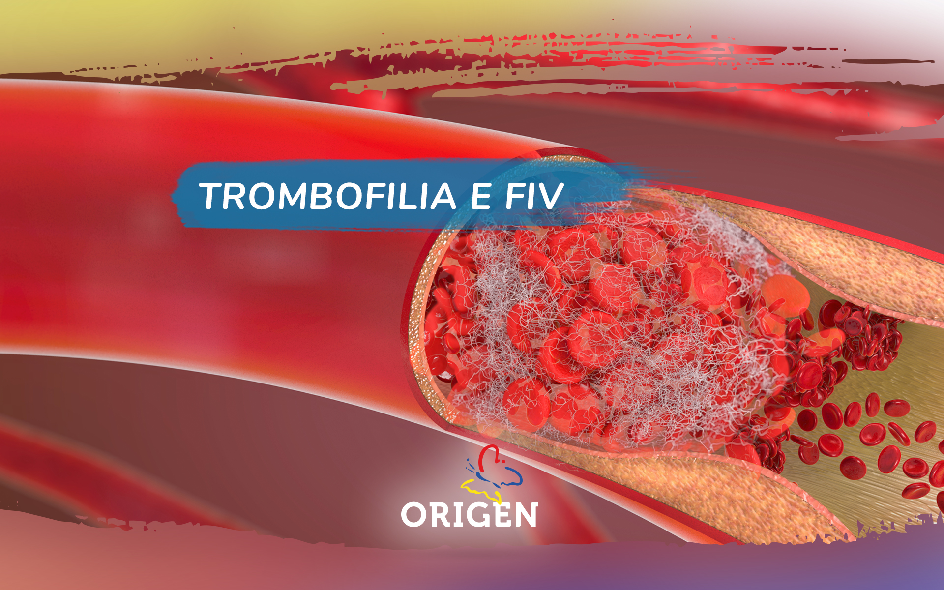Trombofilia e FIV
