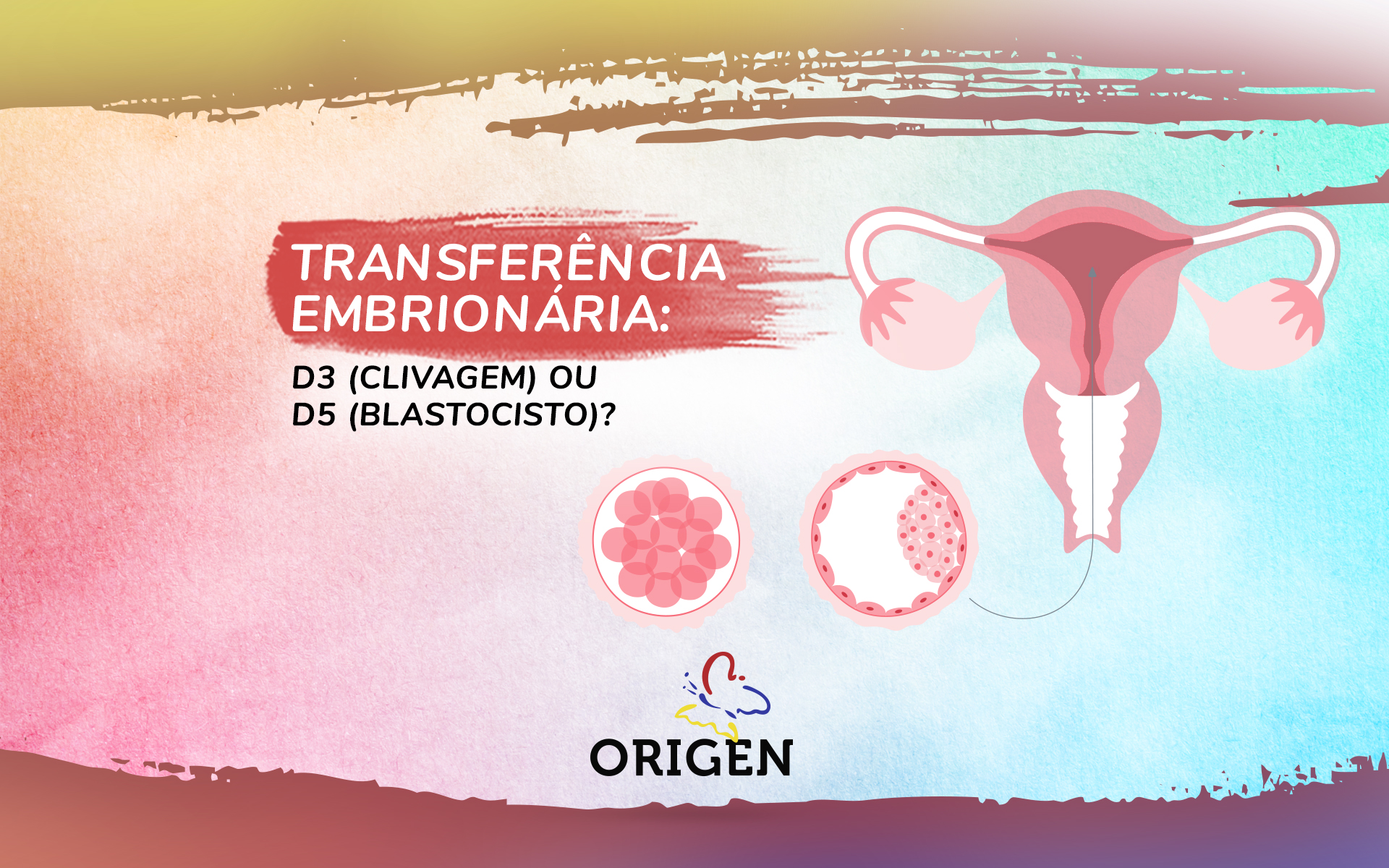 Transferência embrionária: D3 (clivagem) ou D5 (blastocisto)?