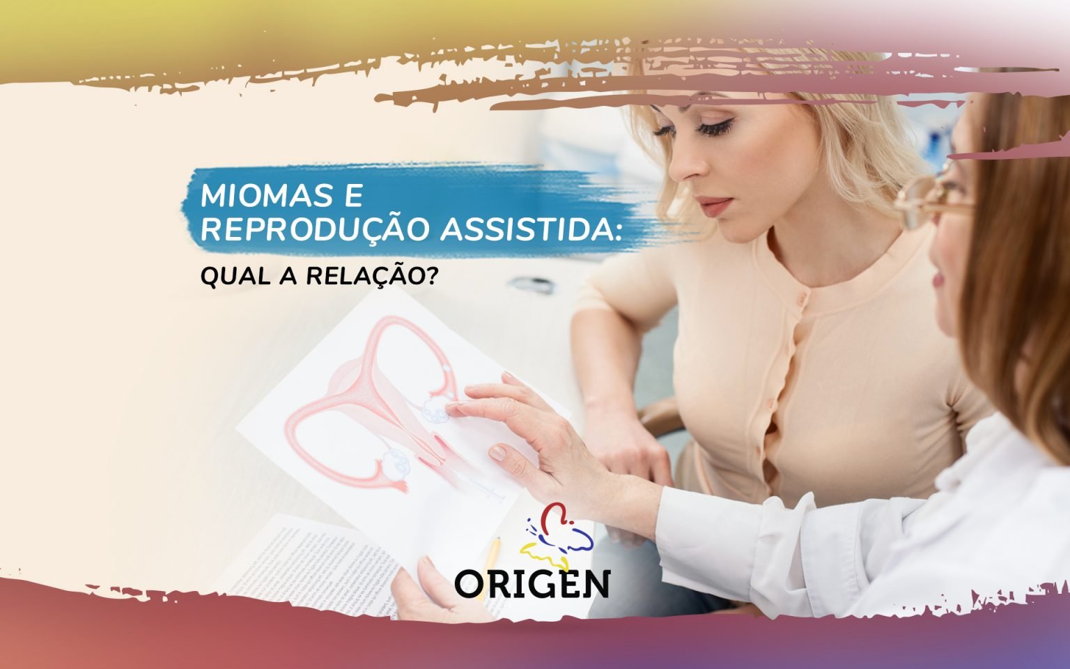 Miomas E Reprodução Assistida Qual A Relação Clínica Origen