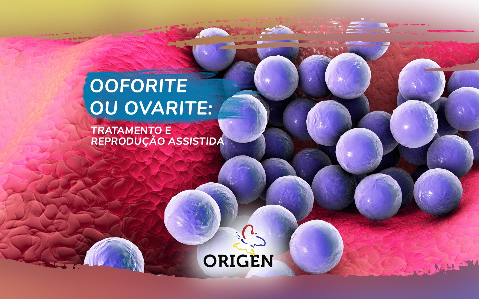 Ooforite - Saiba tudo sobre Ooforite