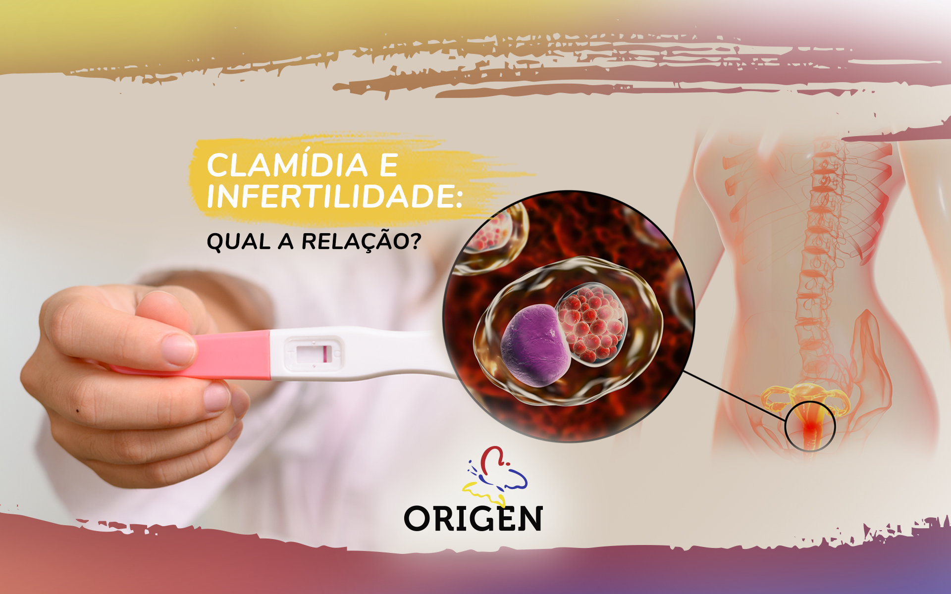 Clamídia e infertilidade: qual a relação?
