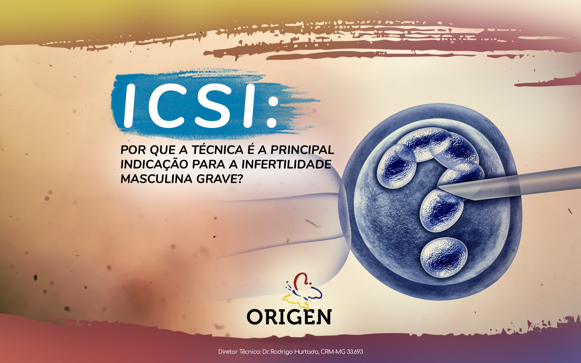 ICSI: por que a técnica é a principal indicação para a infertilidade masculina grave?
