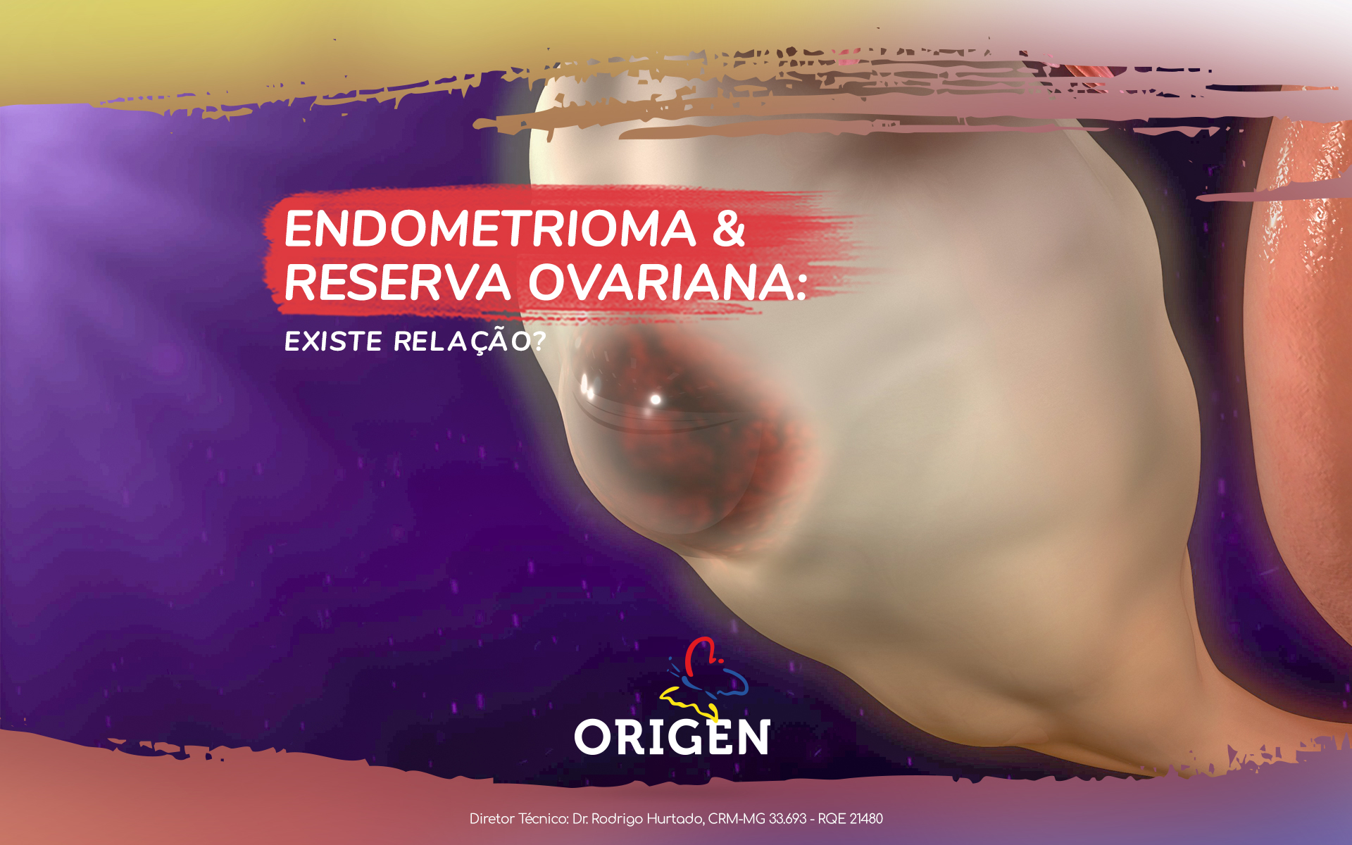 Endometrioma e reserva ovariana: existe relação?