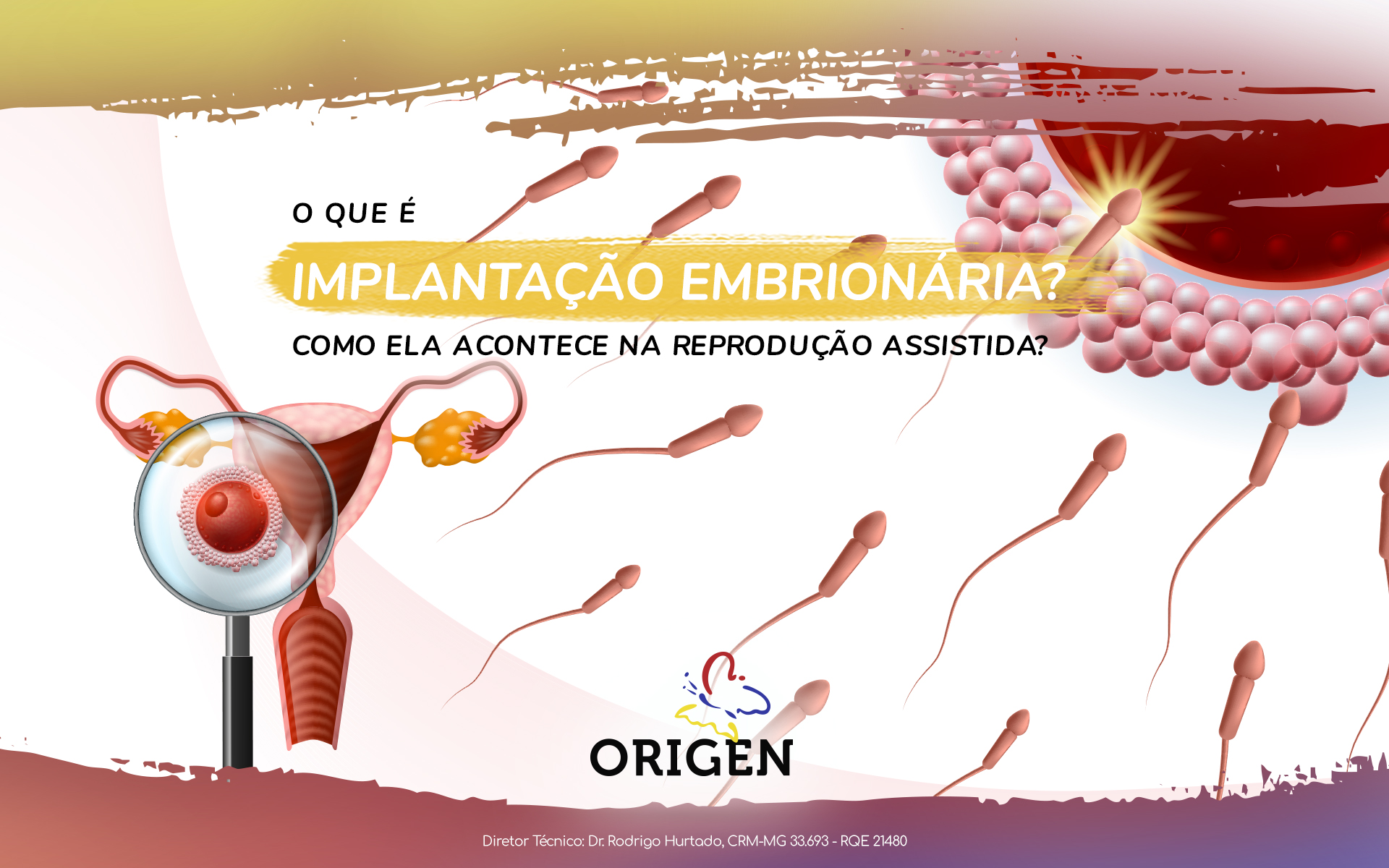 O que é implantação embrionária? Como ela acontece na reprodução assistida?