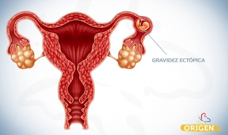 O Que é Gravidez Ectópica E O Que Fazer Clínica Origen Fertilização In Vitro 