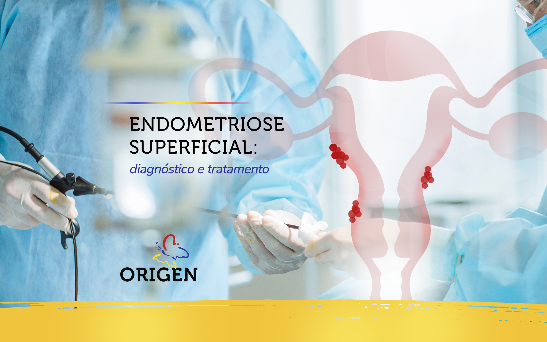 Endometriose superficial: diagnóstico e tratamento