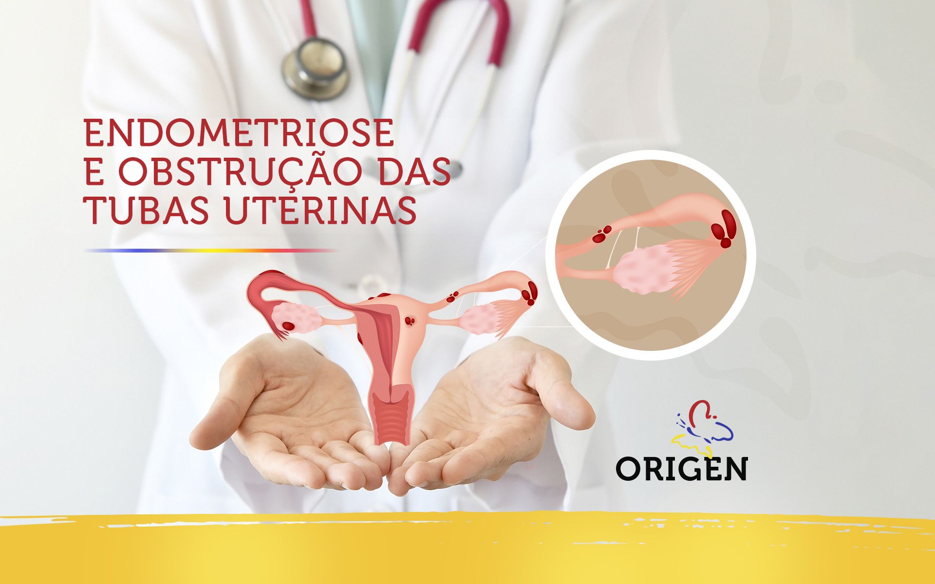 Endometriose e obstrução das tubas uterinas