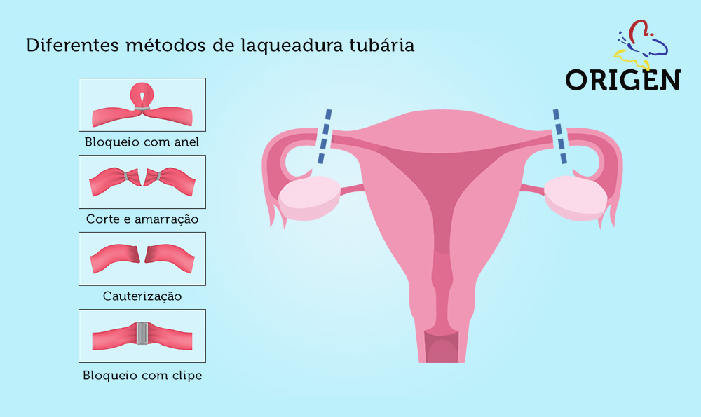 Laqueadura Tubária - Instituto Feminina - Cirurgia ginecológica