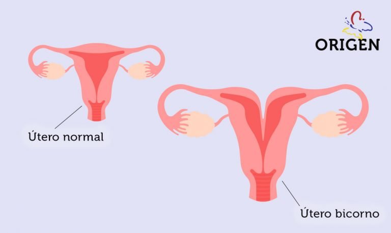 Útero Bicorno E Infertilidade Como Se Relacionam Clínica Origen