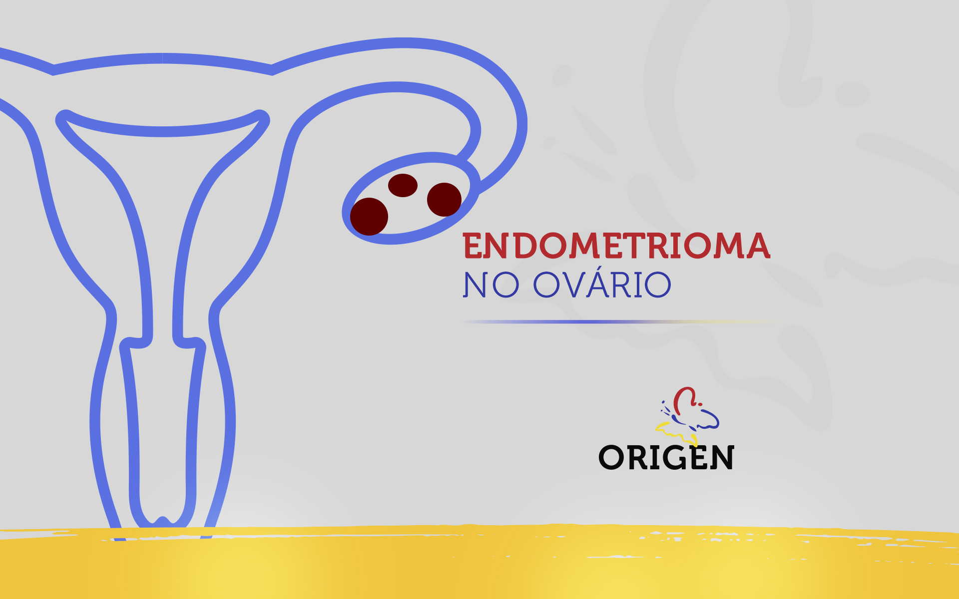 Endometrioma no ovário