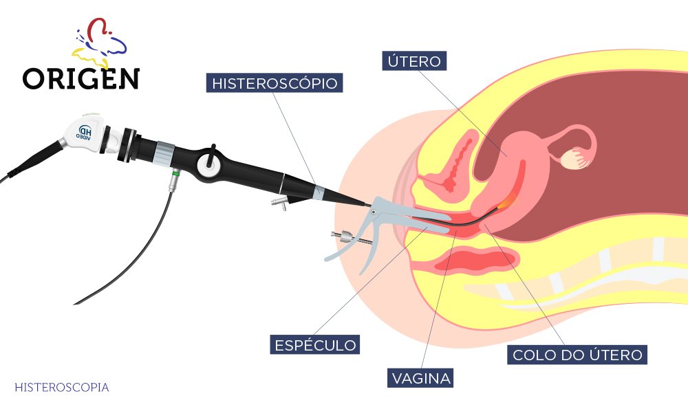 Endoscopia Ginecológica