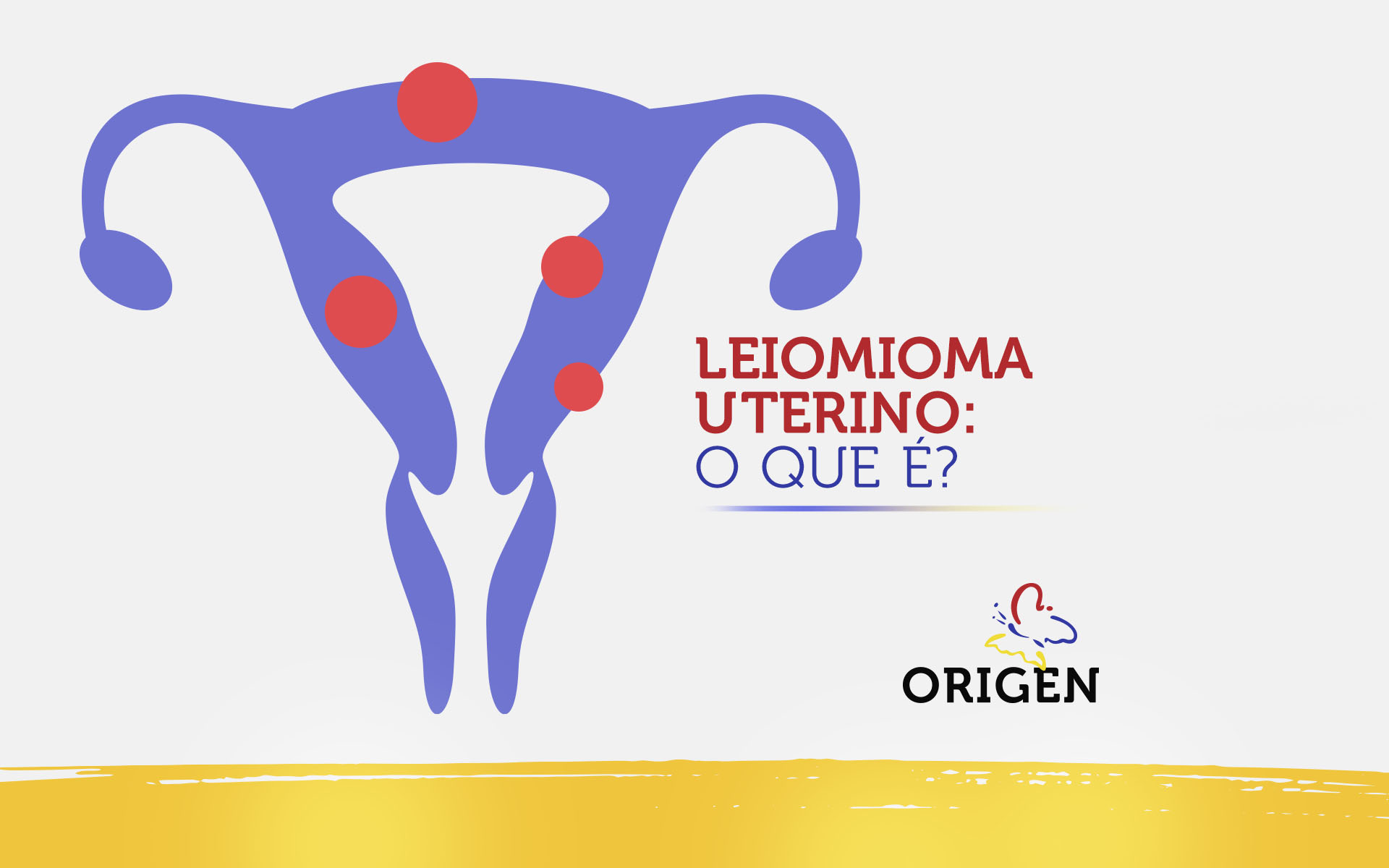 Leiomioma uterino: o que é?