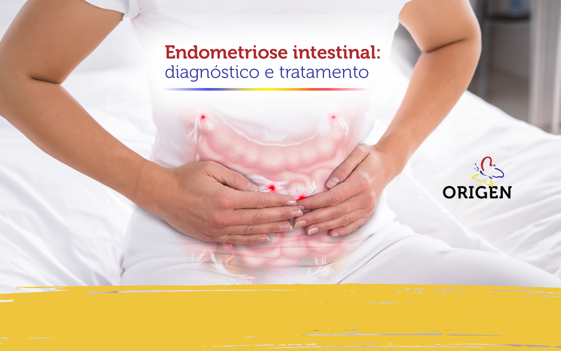 Endometriose intestinal: diagnóstico e tratamento