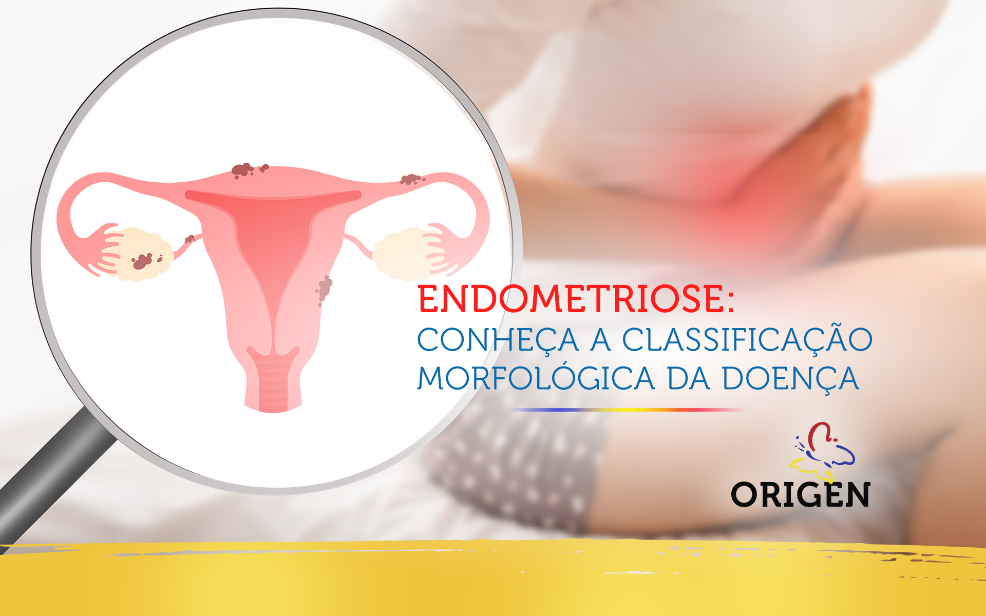 Endometriose: conheça a classificação morfológica da doença
