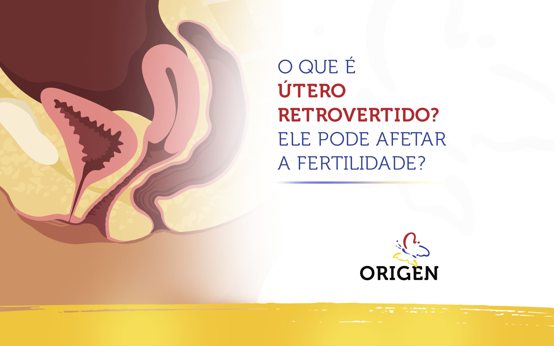 O que é útero retrovertido? Ele pode afetar a fertilidade?