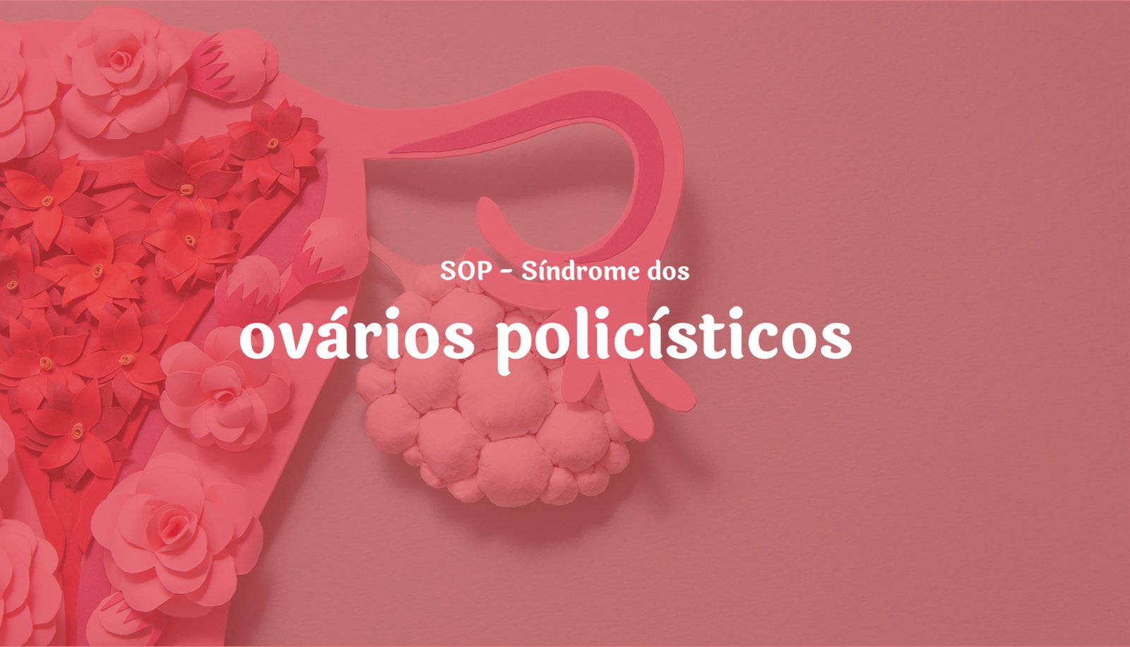 SOP-sindrome-do-ovario-policisticos-clinica-origen